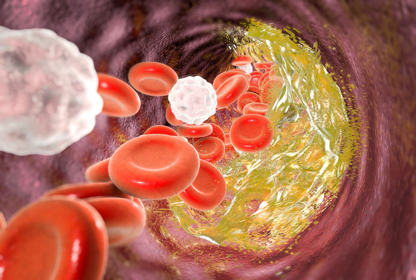 Blood Cholesterol Management