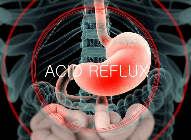Heartburn Relief - Acid Reflux & GERD Treatments