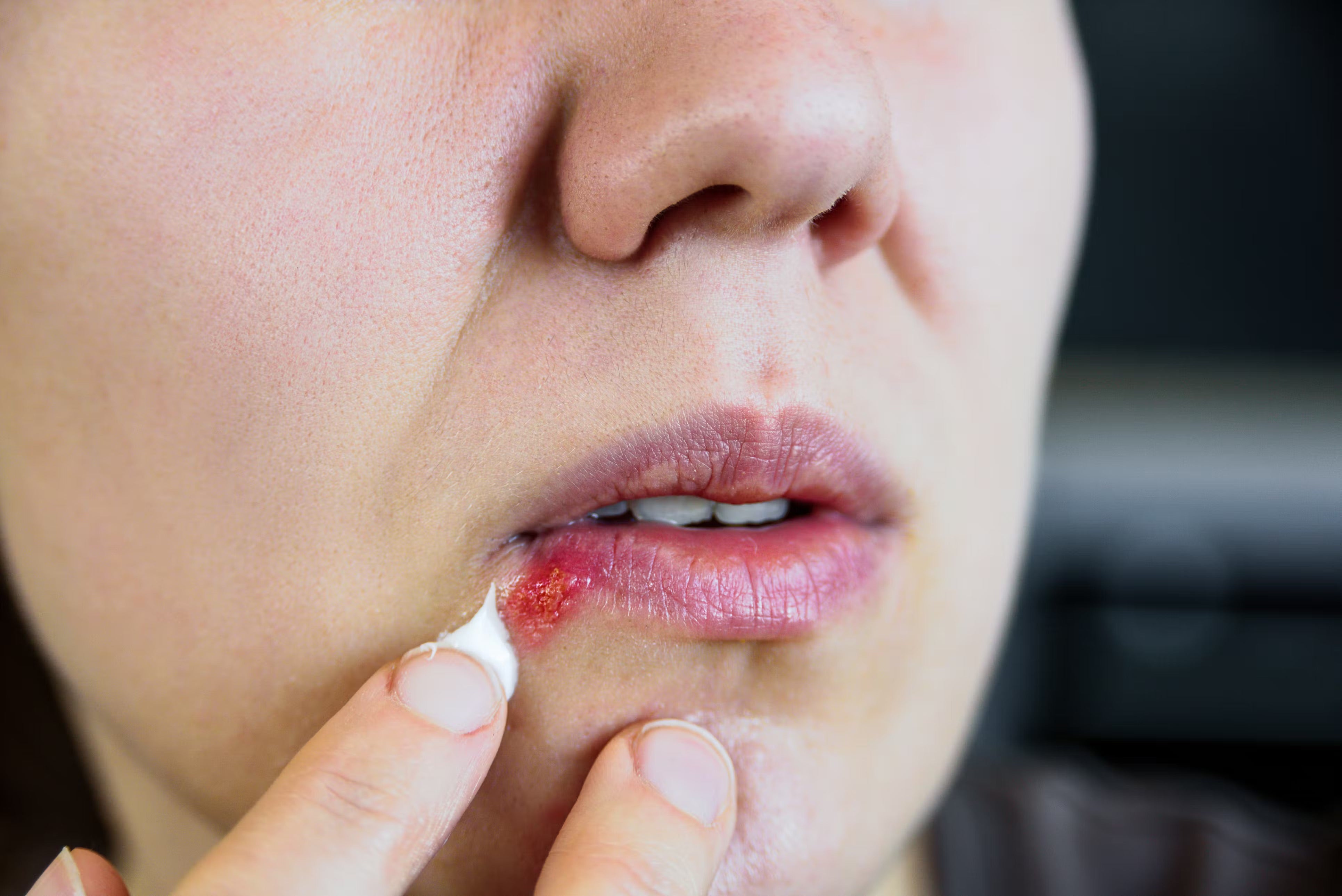 Cold Sore Treatment Cream | Abreva | 2 g