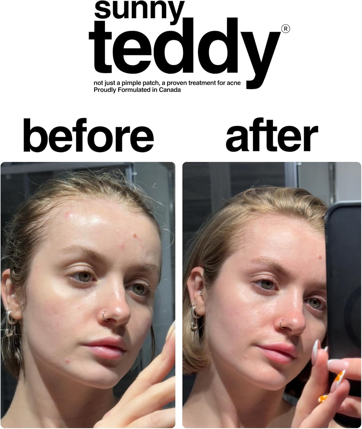 Acne Treatment Patches | Sunny Teddy | 72 Pink Teddy Patches