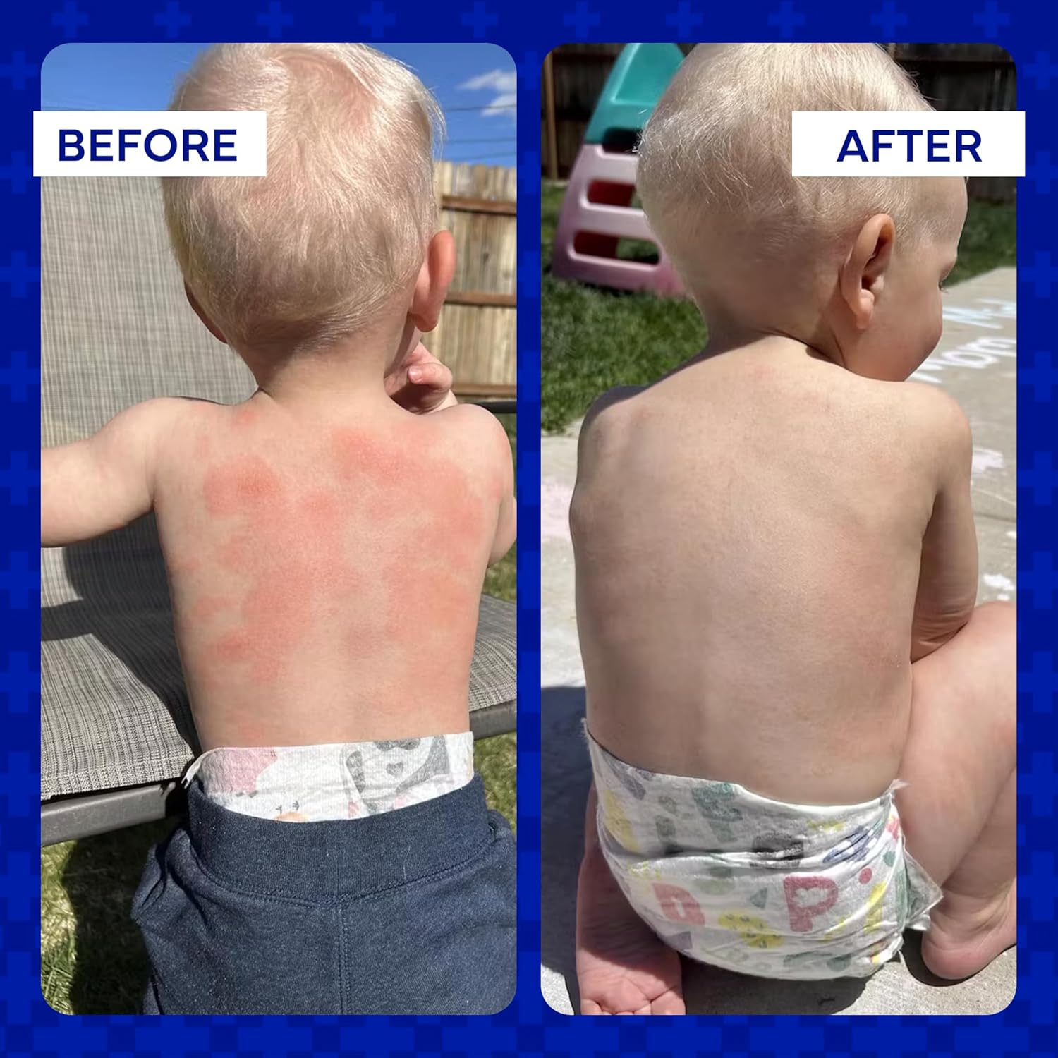 Ointment for Eczema and Psoriasis Relief | emuaid® | 59 mL