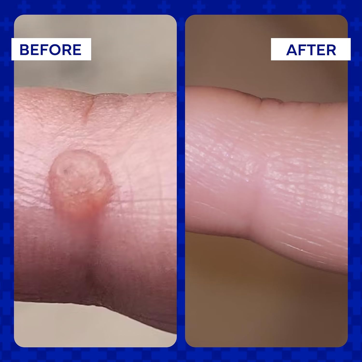 Ointment for Eczema and Psoriasis Relief | emuaid® | 59 mL