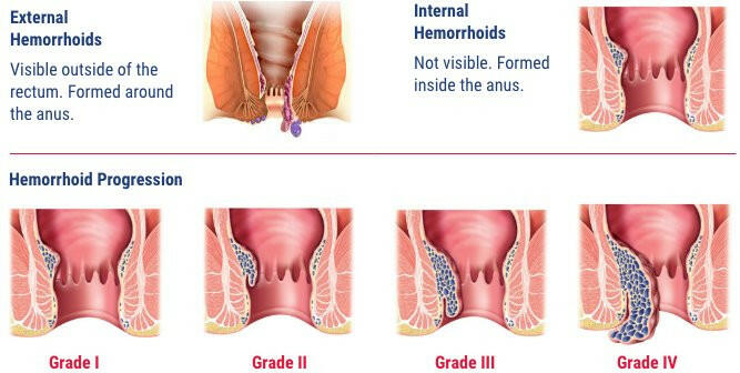 Hemorrhoids | Venixxa® | 36 Tablets
