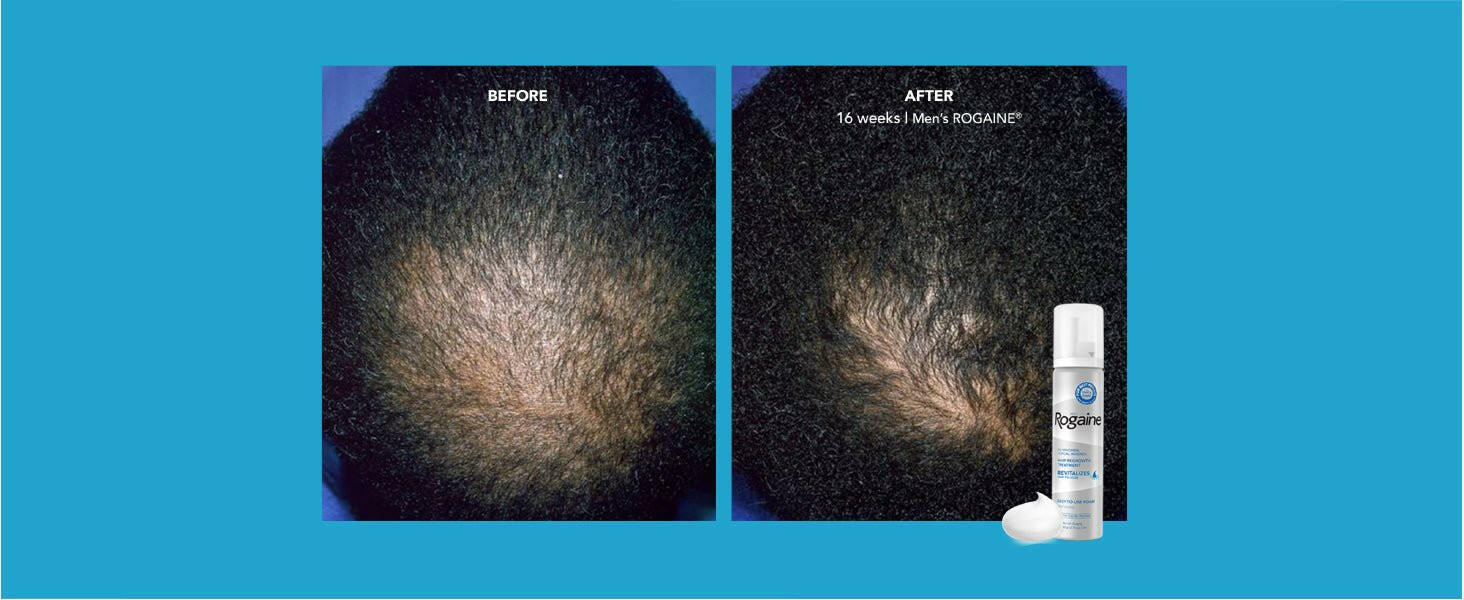 MEN's Rogaine® Foam | Johnson & Johnson | 3 x 60g - Coal Harbour Pharmacy