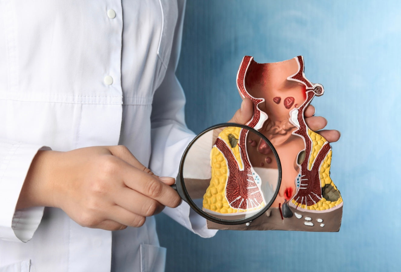 Hemorrhoid Relief