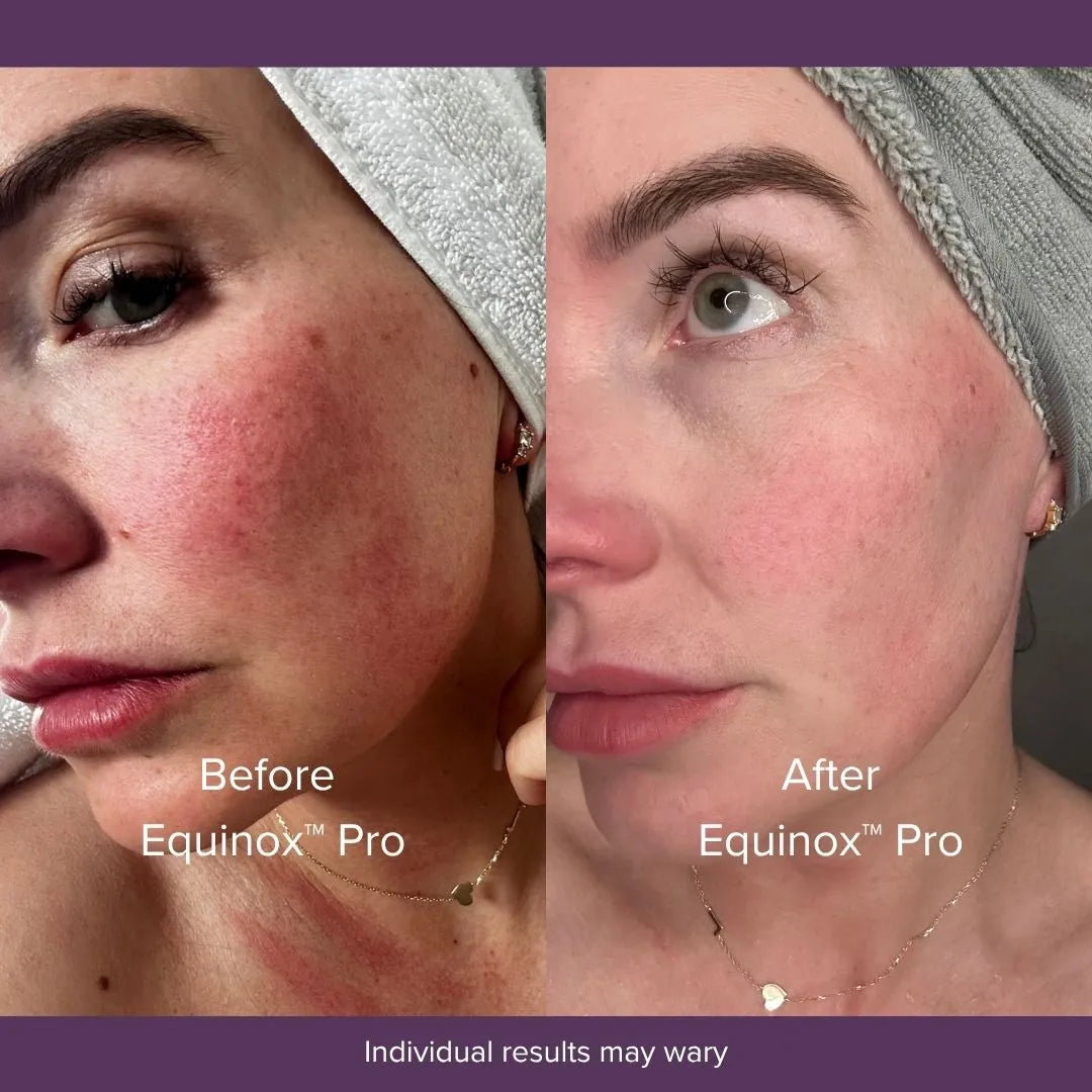 Equinox™ Pro LED Mask