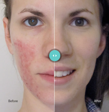 Anti-Redness Serum | Riversol | 60ml