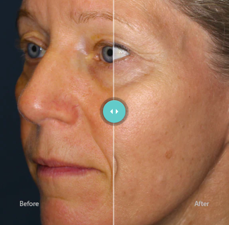 Anti-Redness Serum | Riversol | 60ml